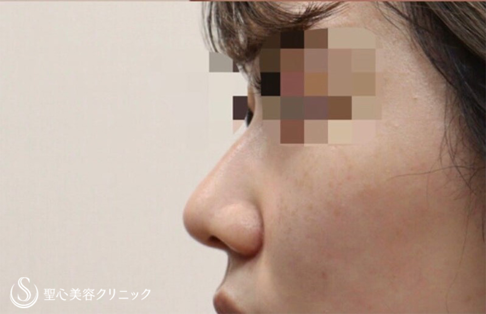 鼻尖縮小+鼻尖形成（耳介軟骨移植）+小鼻縮小_After