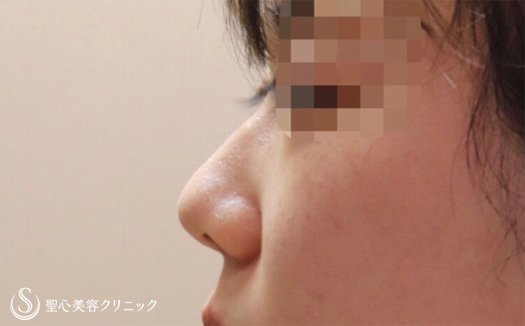 鼻尖縮小+鼻尖形成（耳介軟骨移植）+小鼻縮小_Before