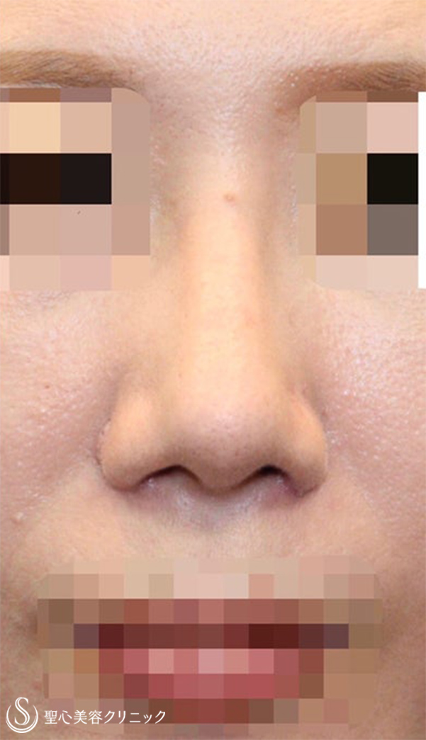 鼻尖縮小+鼻尖形成（耳介軟骨移植）+プロテーゼによる隆鼻術+小鼻縮小_After