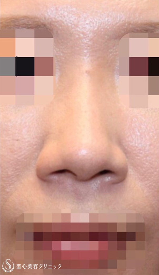 鼻尖縮小+鼻尖形成（耳介軟骨移植）+プロテーゼによる隆鼻術+小鼻縮小_Before