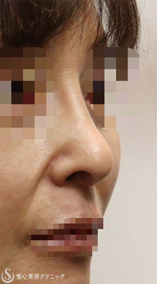 鼻中隔延長術+鼻尖形成（耳介軟骨移植）+プロテーゼによる隆鼻術+他院修正(軟骨除去)_After