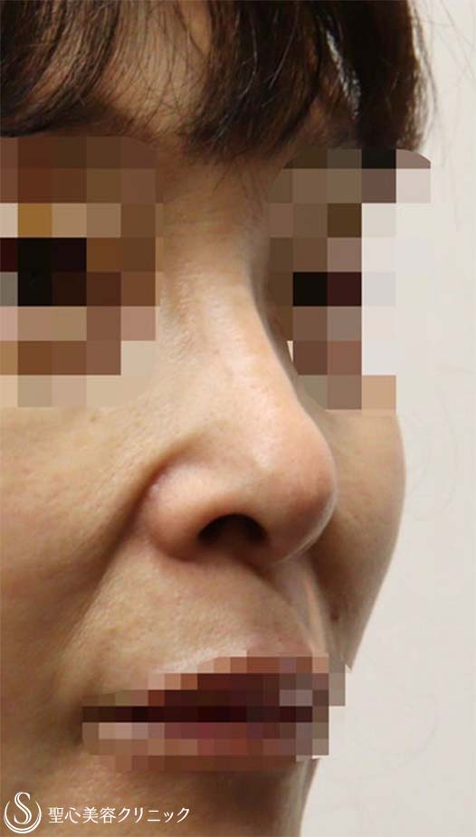 鼻中隔延長術+鼻尖形成（耳介軟骨移植）+プロテーゼによる隆鼻術+他院修正(軟骨除去)_Before