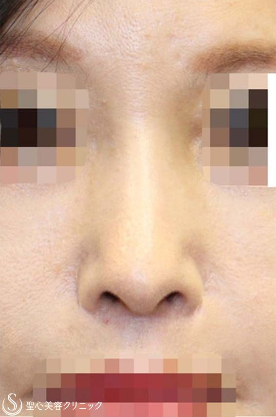 鼻中隔延長術+鼻尖形成（耳介軟骨移植）+プロテーゼ入替（鼻）+他院修正_After