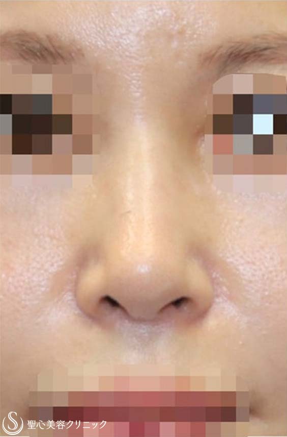 鼻中隔延長術+鼻尖形成（耳介軟骨移植）+プロテーゼ入替（鼻）+他院修正_Before
