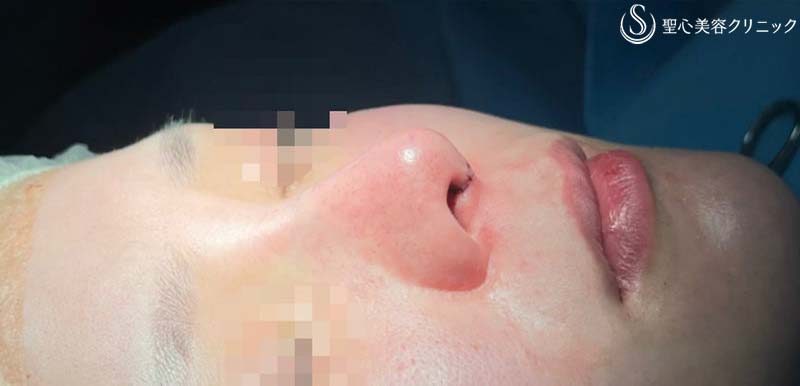 鼻尖縮小+鼻尖形成（耳介軟骨移植）+プロテーゼによる隆鼻術_After