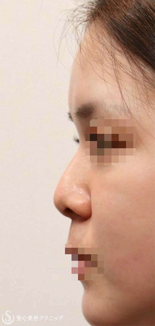 鼻尖縮小+鼻尖形成（耳介軟骨移植）+プロテーゼによる隆鼻術_Before
