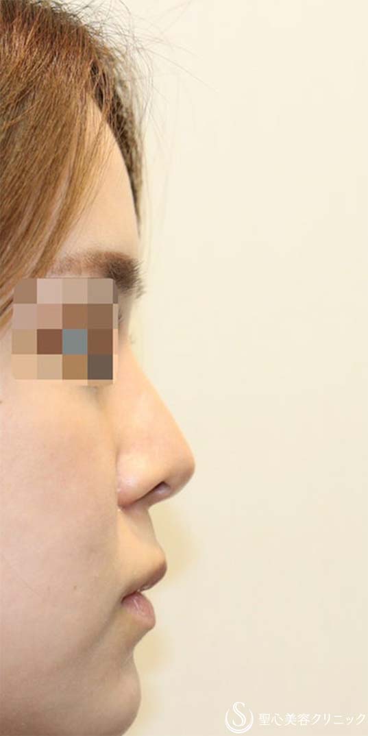 鼻尖縮小+鼻尖形成（耳介軟骨移植）+プロテーゼによる隆鼻術_After