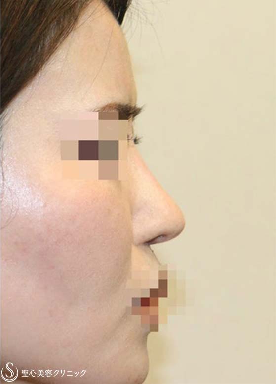 鼻中隔延長術+鼻尖形成（耳介軟骨移植）+プロテーゼ入替（鼻）_After