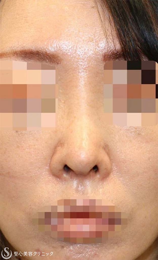 鼻中隔延長術+鼻尖形成（3DPCLドーム）+プロテーゼによる隆鼻術_After