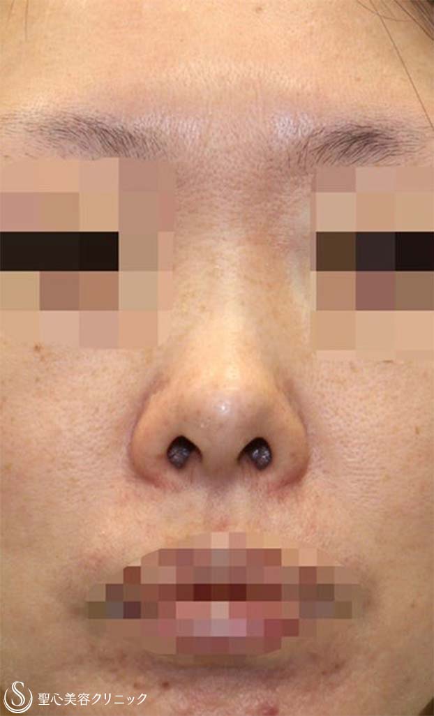 鼻中隔延長術+鼻尖形成（3DPCLドーム）+プロテーゼによる隆鼻術_Before