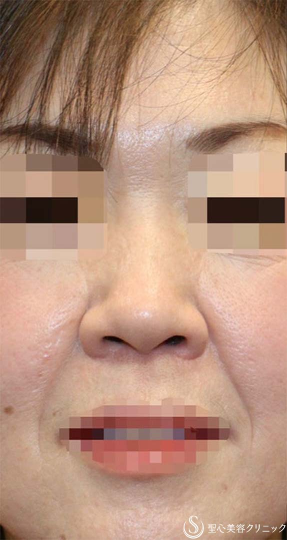 鼻中隔延長術+鼻尖形成（耳介軟骨移植）+鼻背軟骨移植