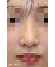 鼻尖縮小＋鼻尖形成（耳介軟骨移植）＋プロテーゼによる隆鼻術_After