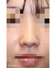 鼻尖縮小＋鼻尖形成（耳介軟骨移植）＋プロテーゼによる隆鼻術_Before