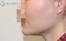 フェイスリフト_After