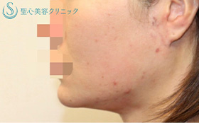 フェイスリフト_Before
