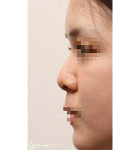 鼻尖縮小+鼻尖形成（耳介軟骨移植）+プロテーゼによる隆鼻術_Before