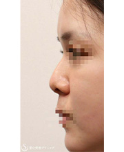 鼻尖縮小＋鼻尖形成（耳介軟骨移植）＋プロテーゼによる隆鼻術_Before