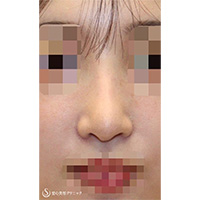 鼻尖縮小+鼻尖形成（耳介軟骨移植）+プロテーゼによる隆鼻術_After