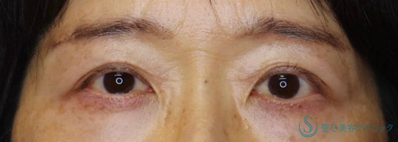 眉下切開法（眉下リフト）&二重術（埋没法）：マイクロメソッド+α&プレミアムPRP皮膚再生療法_After