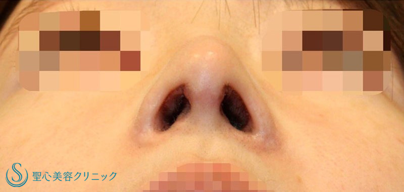 鼻中隔延長術+鼻尖形成（耳介軟骨移植）+鼻孔縁下降術：他院修正_After
