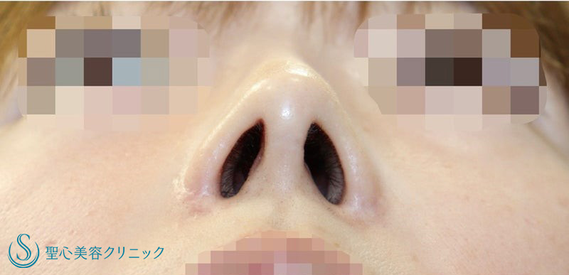 鼻中隔延長術+鼻尖形成（耳介軟骨移植）+鼻孔縁下降術：他院修正_Before