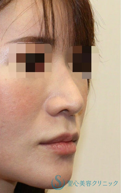 鼻中隔延長術+鼻尖形成（耳介軟骨移植）+プロテーゼ入替（鼻）_Before