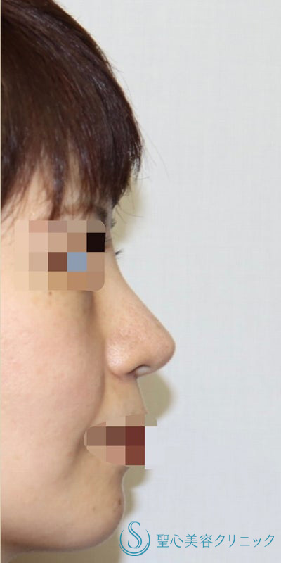 鼻中隔延長術+鼻尖形成（耳介軟骨移植）+プロテーゼ入替（鼻）_After