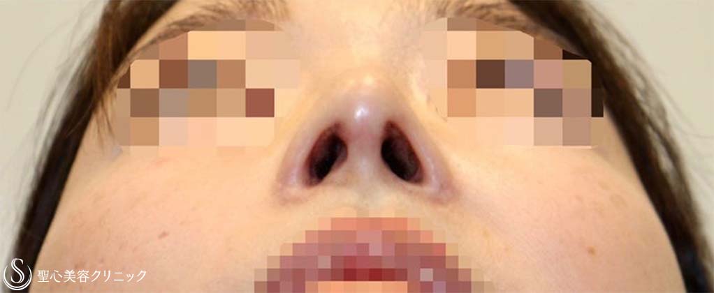 鼻中隔延長術＋鼻尖形成（耳介軟骨移植）＋鼻孔縁下降術＋他院修正_After