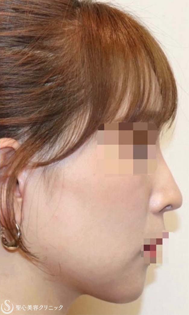 フェイスリフト＋頬の脂肪吸引＋リガメント_After