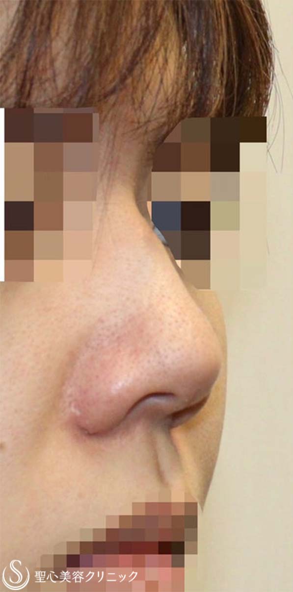 鼻中隔延長術＋鼻尖形成（耳介軟骨移植）＋プロテーゼによる隆鼻術_Before