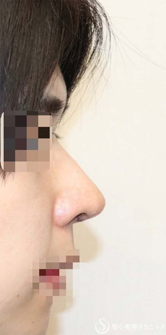 鼻中隔延長術＋鼻尖形成（3DPCLドーム）＋鼻背軟骨移植（肋軟骨）_After
