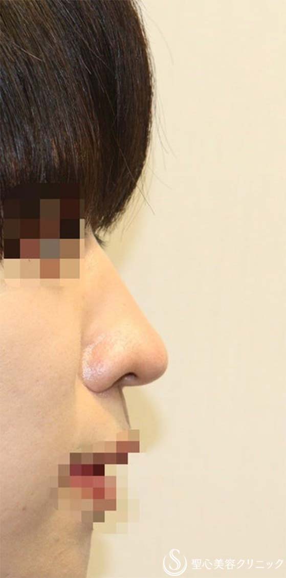 鼻中隔延長術＋鼻尖形成（3DPCLドーム）＋鼻背軟骨移植（肋軟骨）_Before