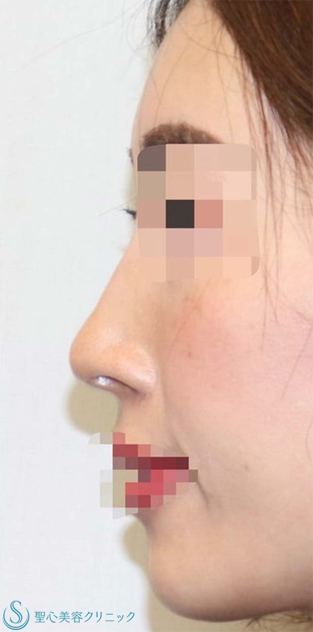 オステオポール抜去＋変形した鼻尖の再建＋鼻尖形成（耳介軟骨移植）_After