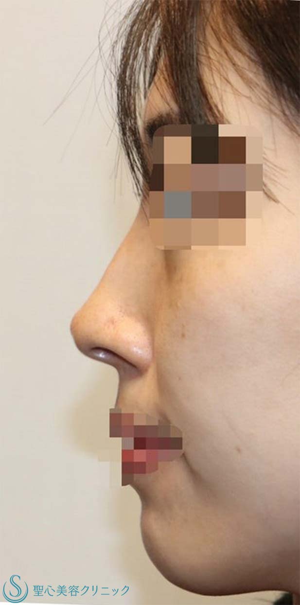 オステオポール抜去＋変形した鼻尖の再建＋鼻尖形成（耳介軟骨移植）_Before