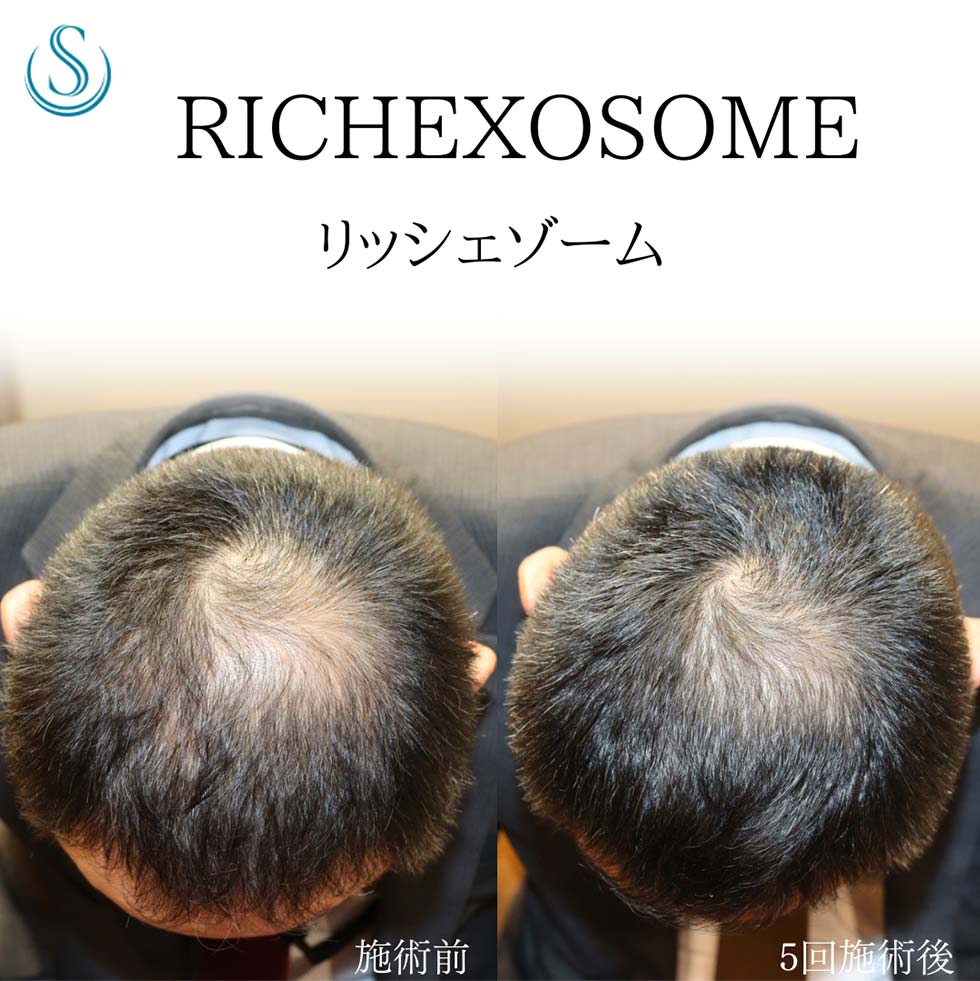 RichExosome（リッシェゾーム）_After