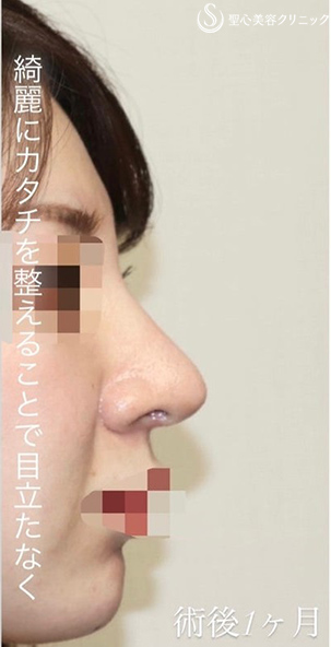 鼻中隔延長術+鼻尖形成（3DPCLドーム）+プロテーゼ入替_After