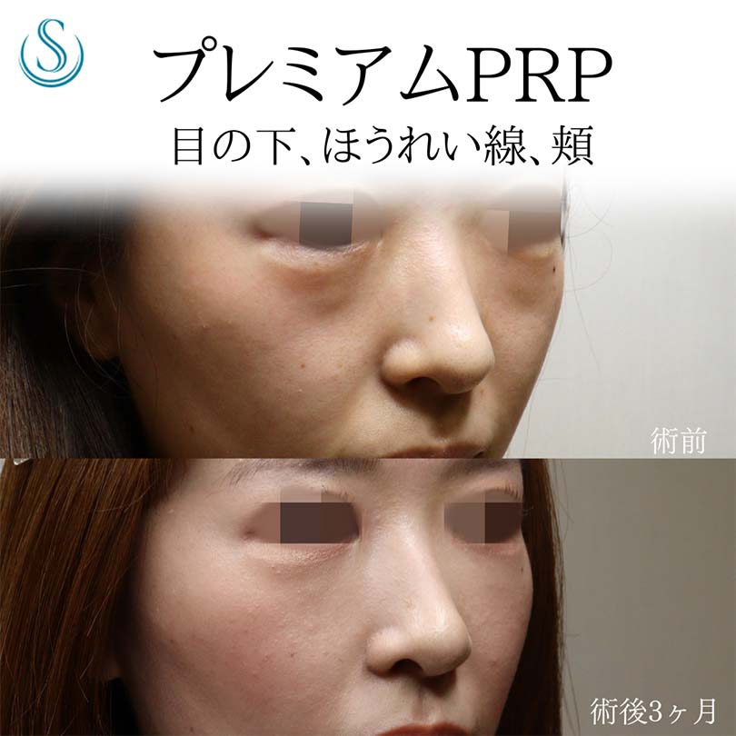 プレミアムPRP皮膚再生療法_Before