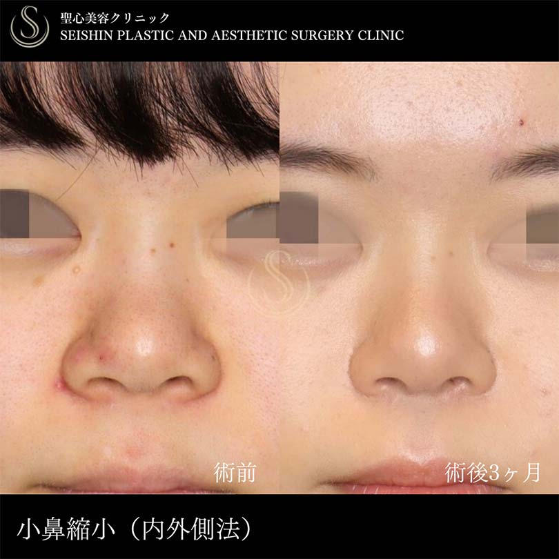 小鼻縮小_Before