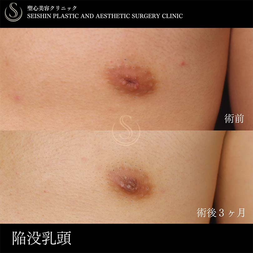 陥没乳頭（陥没乳首）_After