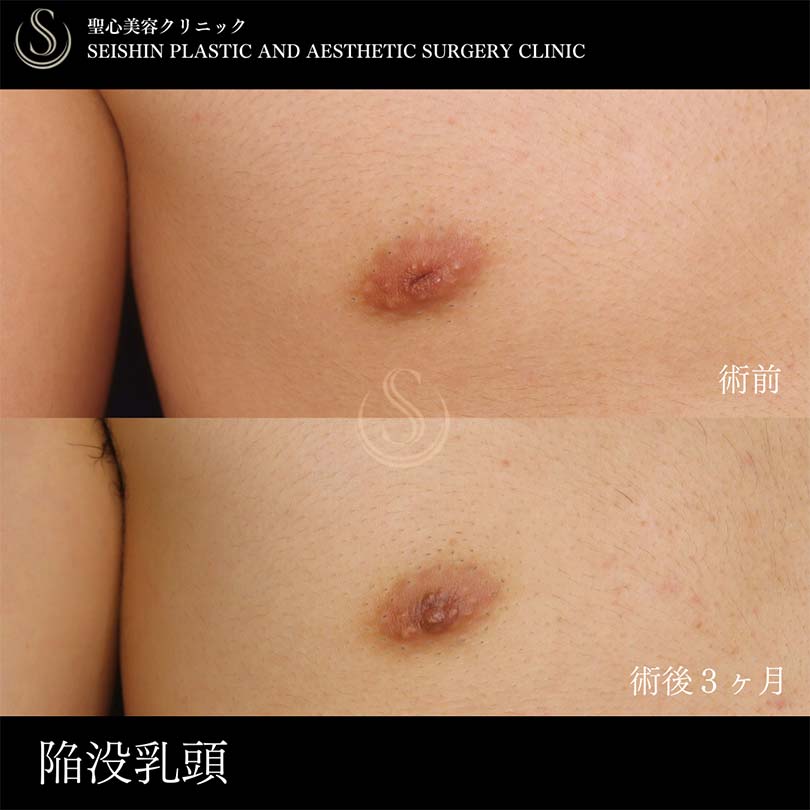陥没乳頭（陥没乳首）_Before