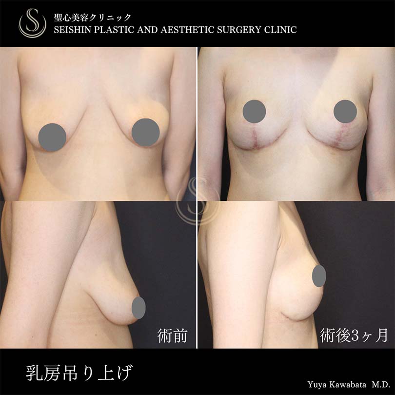 乳房吊り上げ術・乳輪吊り上げ術_After