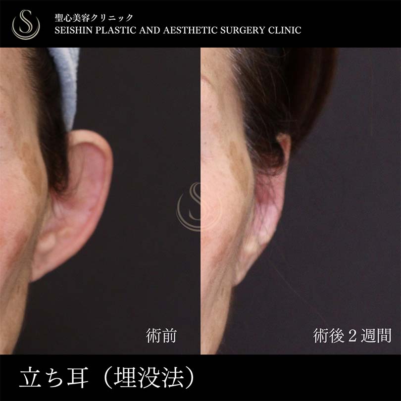 立ち耳修正（埋没法）_Before