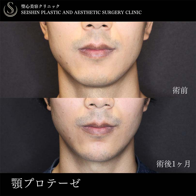 あごプロテーゼ_After