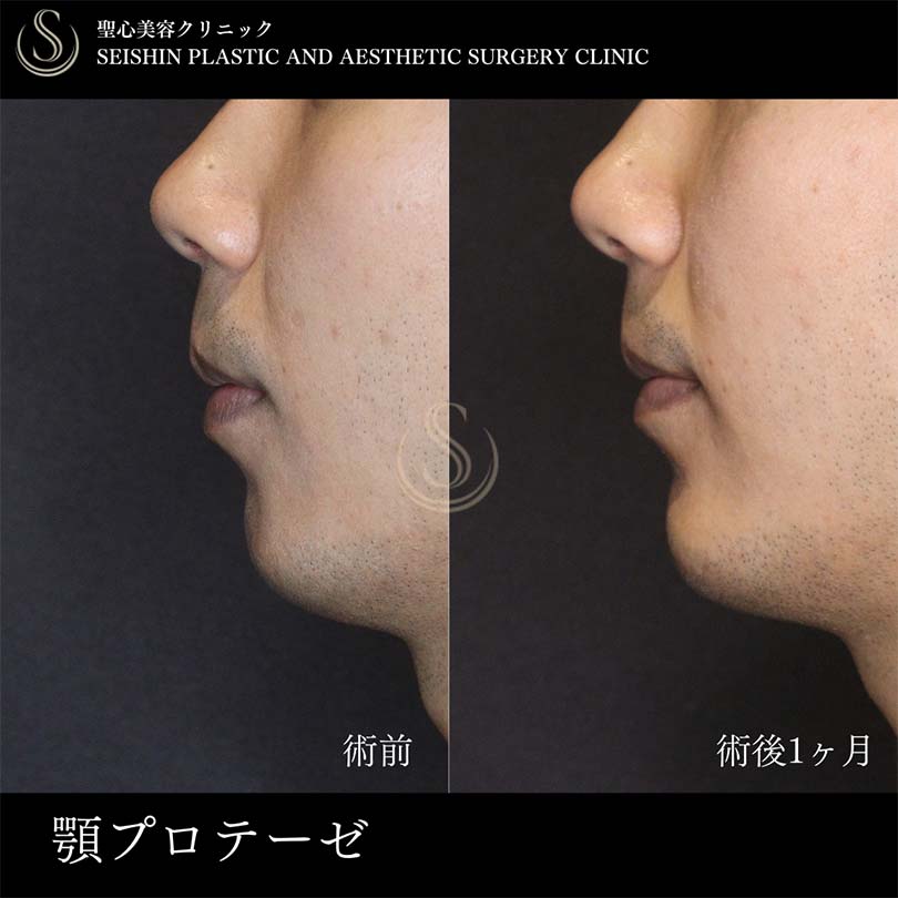 あごプロテーゼ_Before