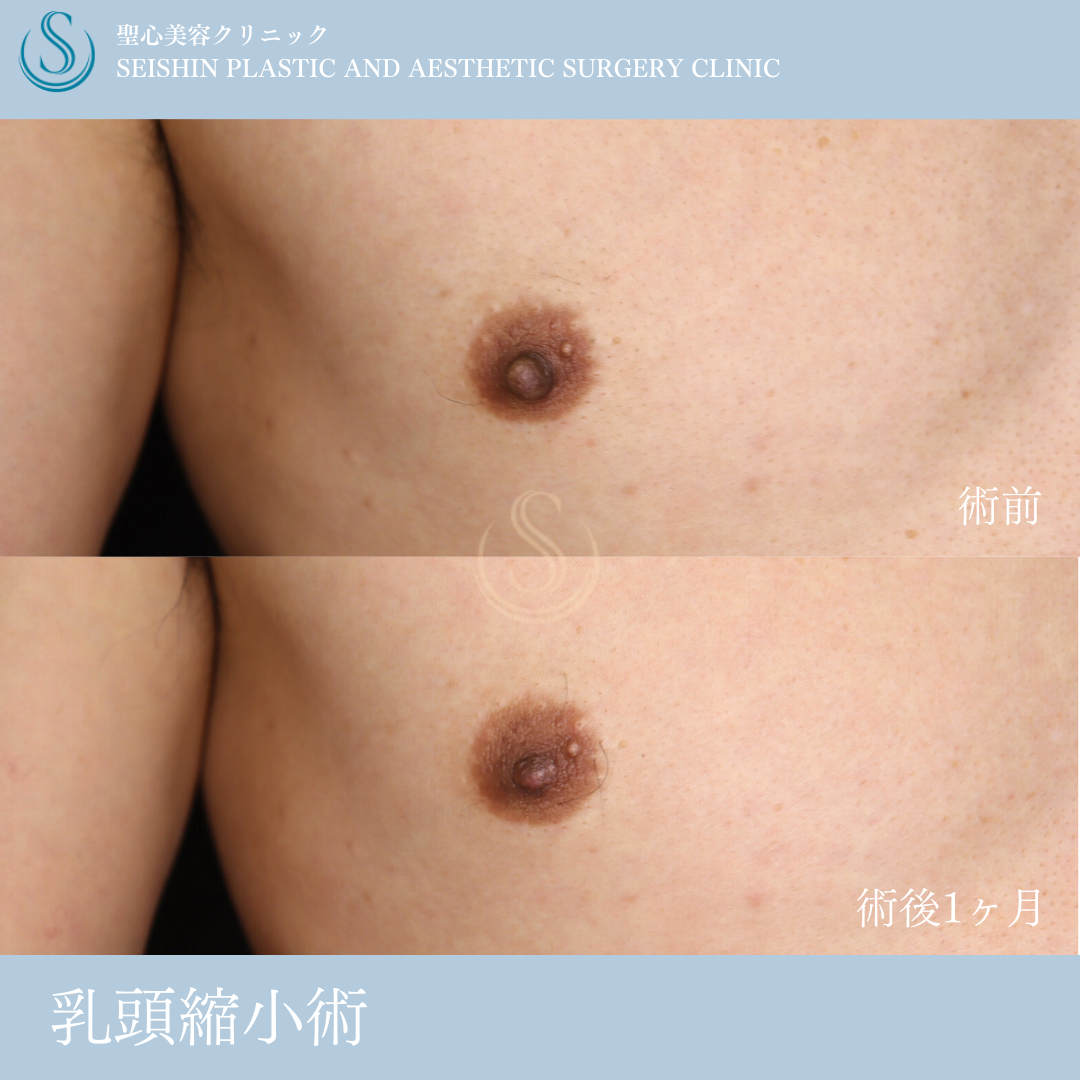 乳頭縮小_After