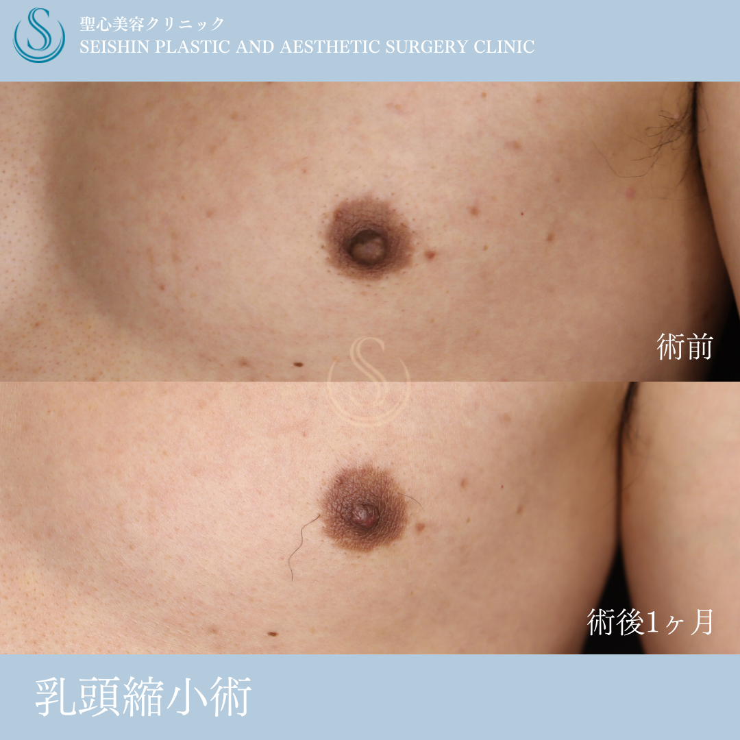 乳頭縮小_Before