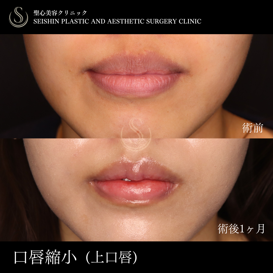 口唇縮小術_After