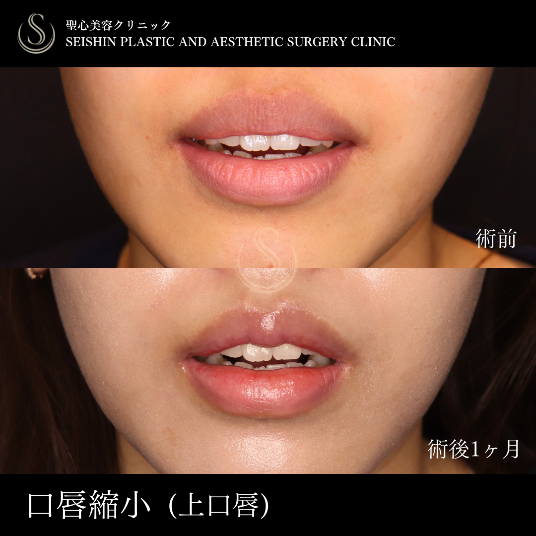 口唇縮小術_Before