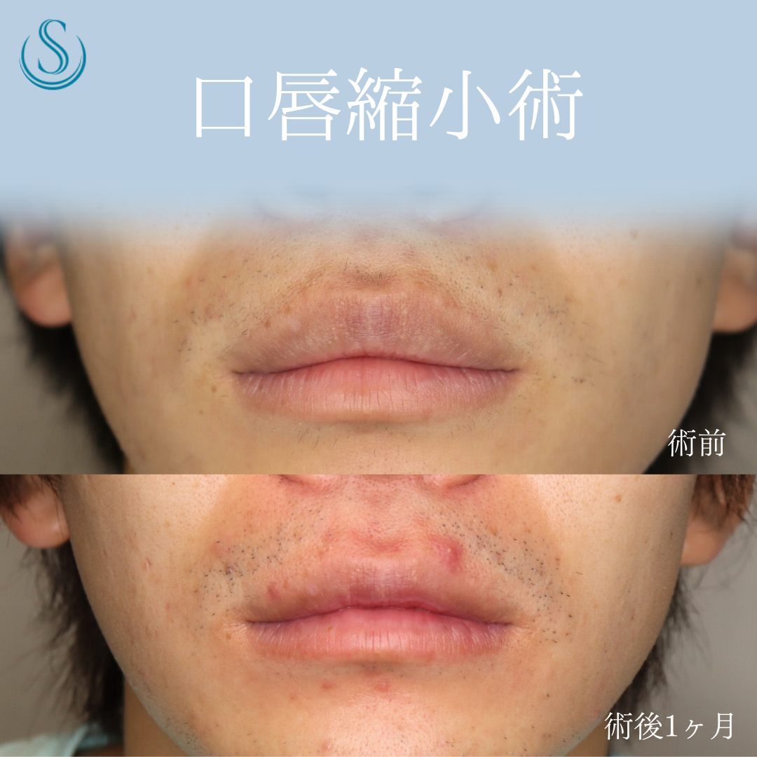 口唇縮小術_Before