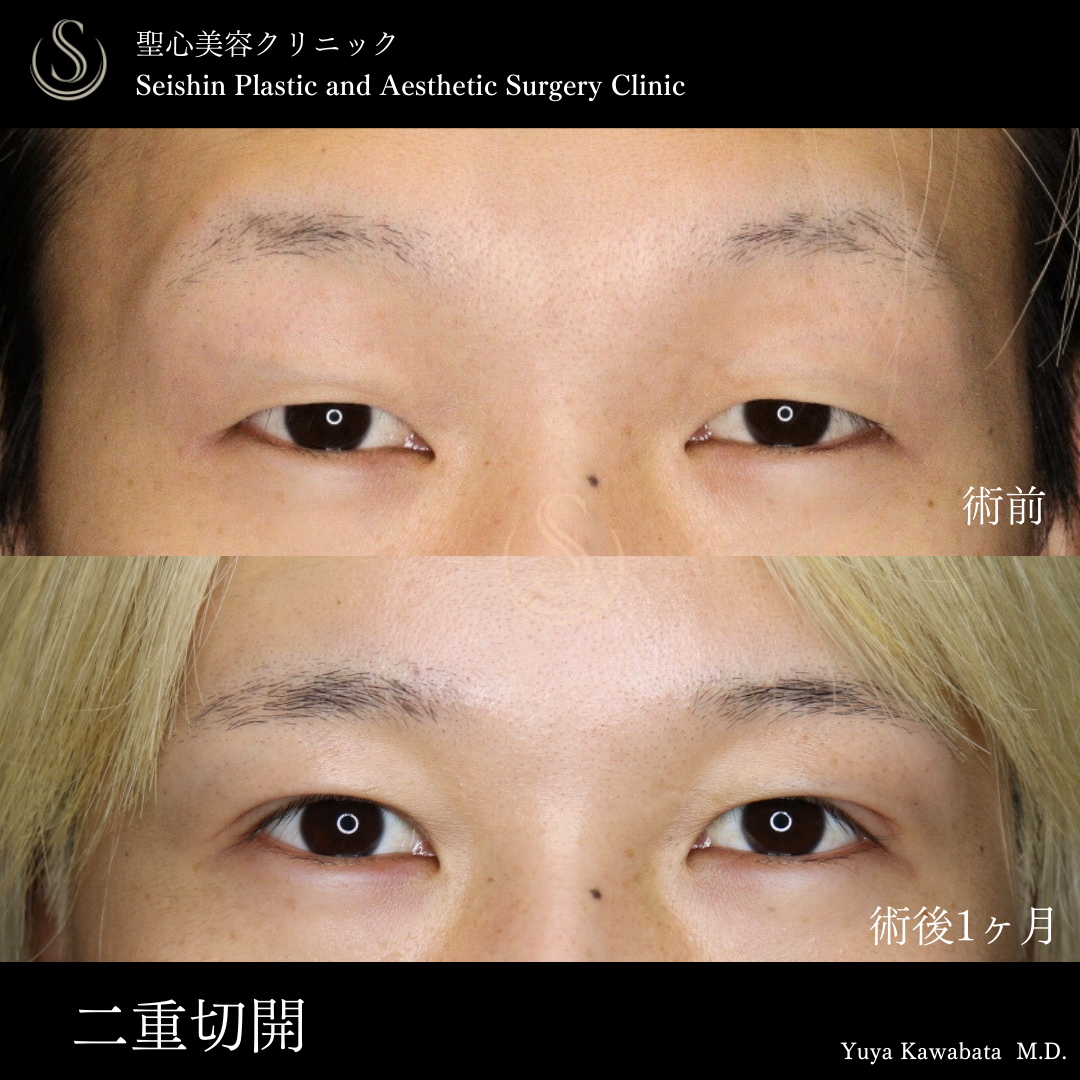 二重術（切開法）部分切開/全切開_Before